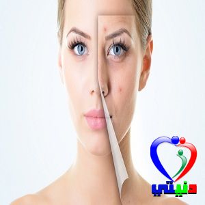 وصفات القضاء على حب الشباب