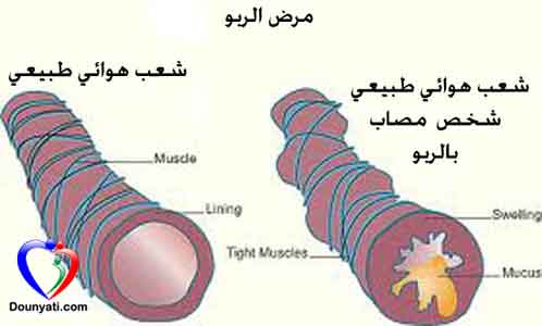 مرض الربو