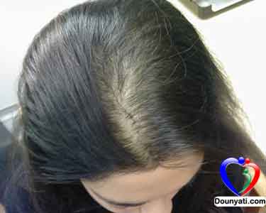 نصائح و وصفات منزلية لعلاج تساقط الشعر