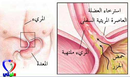 الحموضة أسبابها و علاجها