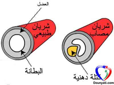 تصلب الشرايين