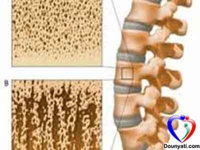 ترقق العظام أسبابه وعلاجه