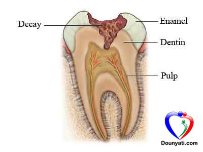عواقب تسوس الاسنان عند الاطفال