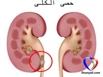 حصى الكلى