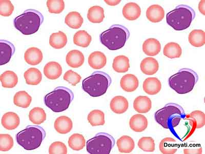 leukemia سرطان الدم