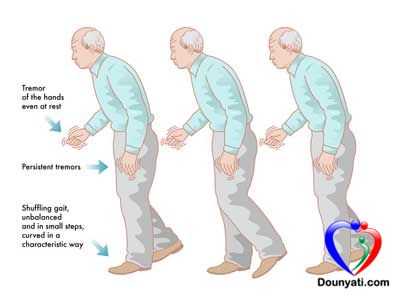 الباركنسون Parkinson