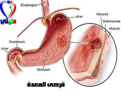 قرحة المعدة