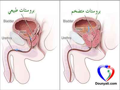 البروستات