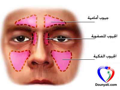 التهاب الجيوب الأنفية