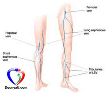 مرض الدوالي أسبابه و علاجه